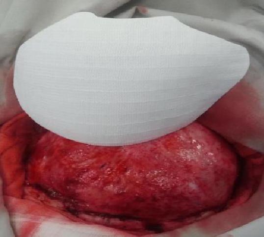 Wszczepienie protezy Codubix 3D_10