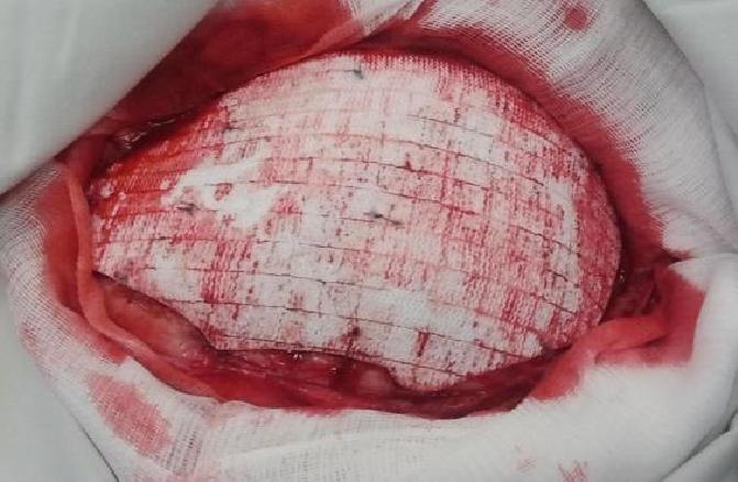 Wszczepienie protezy Codubix 3D_11