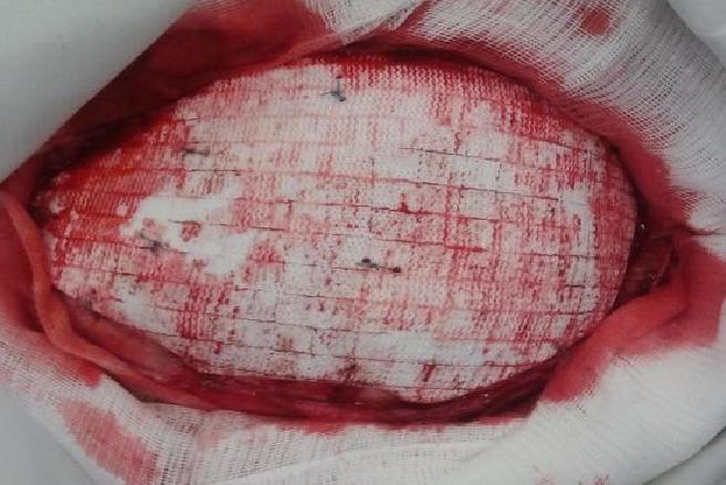 Wszczepienie protezy Codubix 3D_12