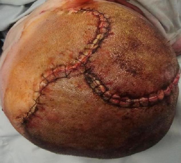 Wszczepienie protezy Codubix 3D_13