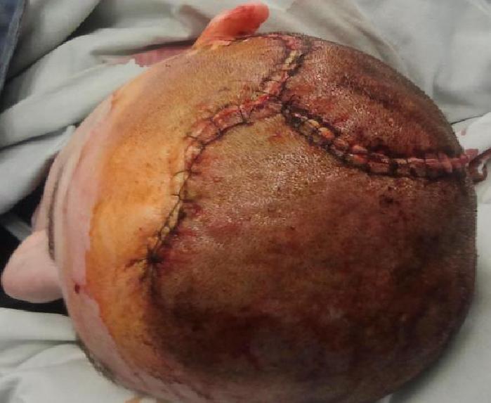 Wszczepienie protezy Codubix 3D_14