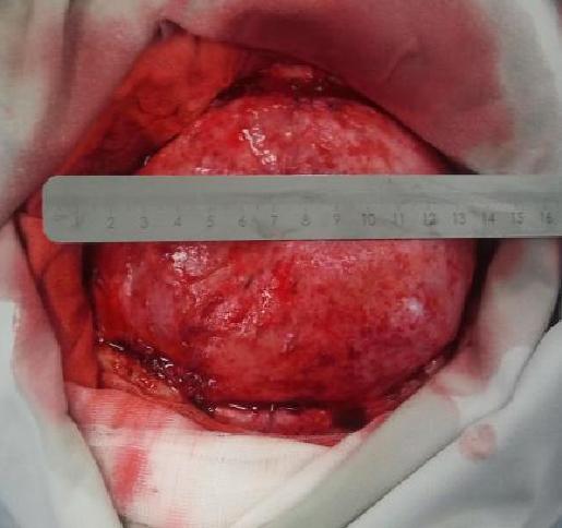 Wszczepienie protezy Codubix 3D_8