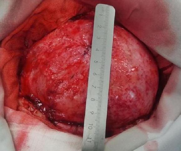 Wszczepienie protezy Codubix 3D_9