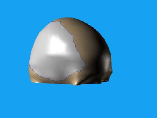 Wszczepienie protezy Codubix 3D_2