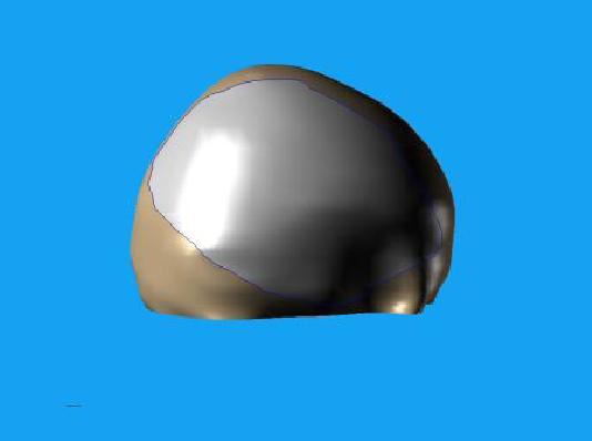 Wszczepienie protezy Codubix 3D_3