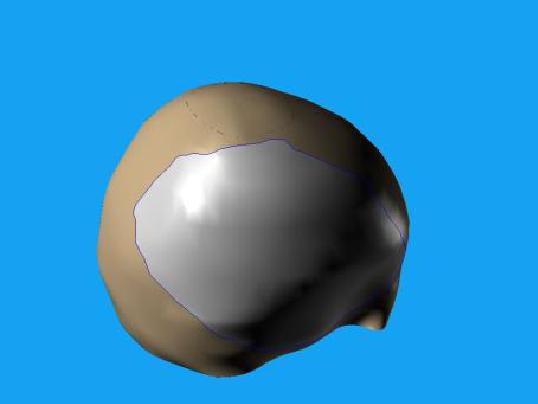 Wszczepienie protezy Codubix 3D_4